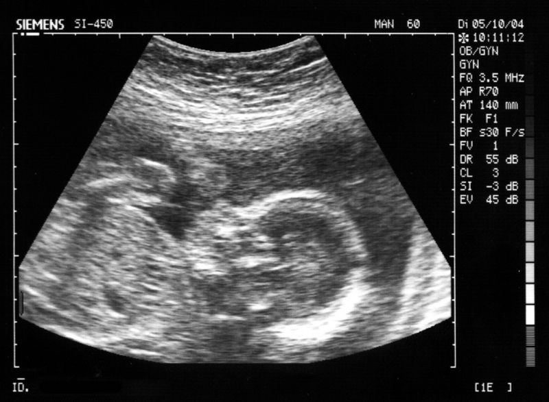 File:Feto di 23 settimane.jpg